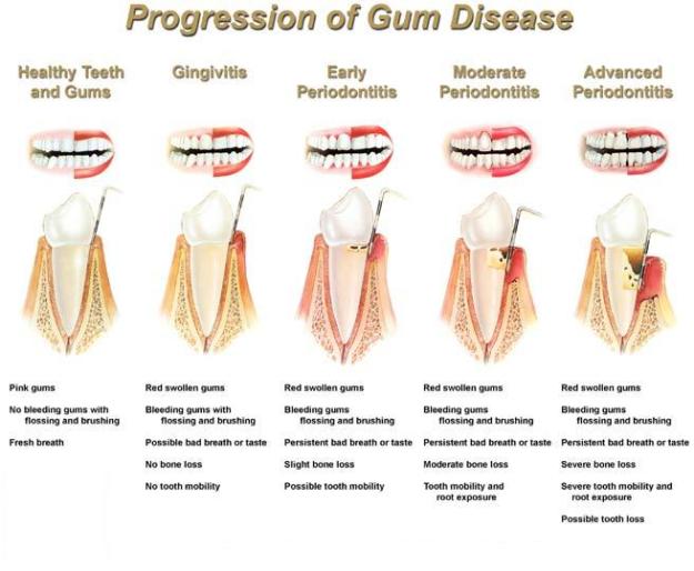 picture of stages of gum disease